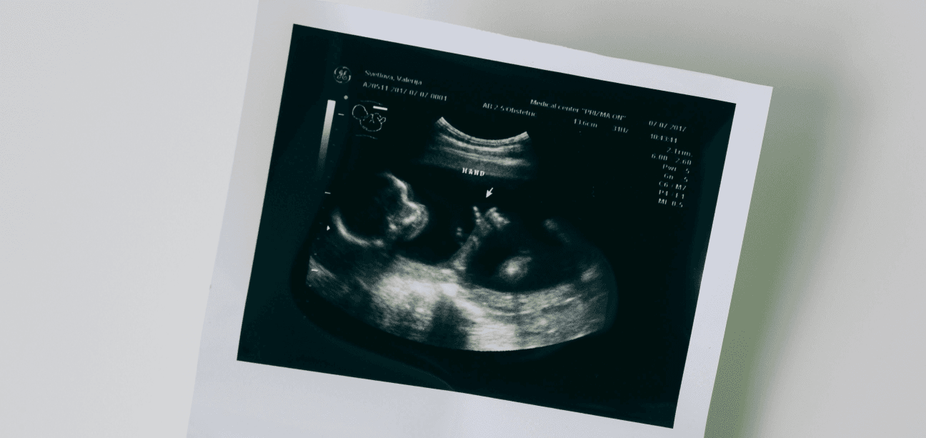 গর্ভে শিশুর অবস্থান—ব্রিচ পজিশন